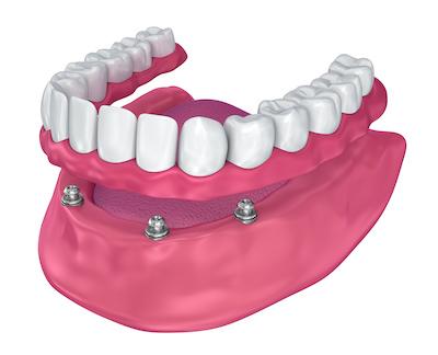 graphic of implant retained dentures