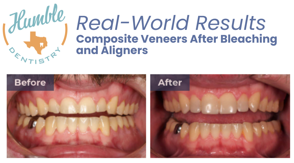 wedding ready smile before and after dental veneers in humble, tx