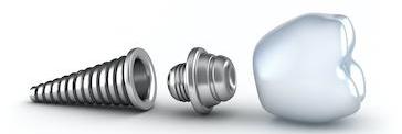 graphic of a dental implant