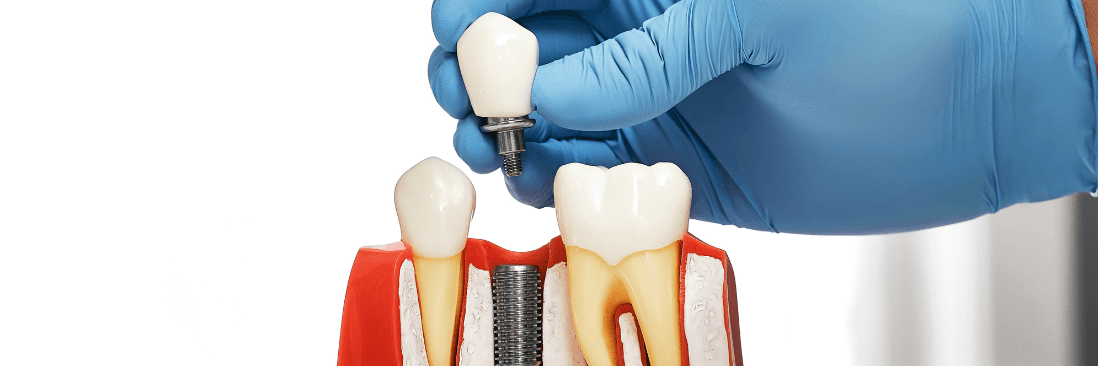 demo for implant retained dentures in humble