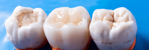 Three extracted molar teeth with visible decay and fillings, displayed on a blue surface.