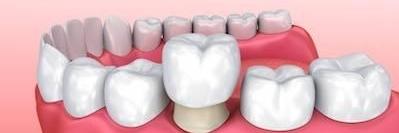 graphic of dental crown on gums