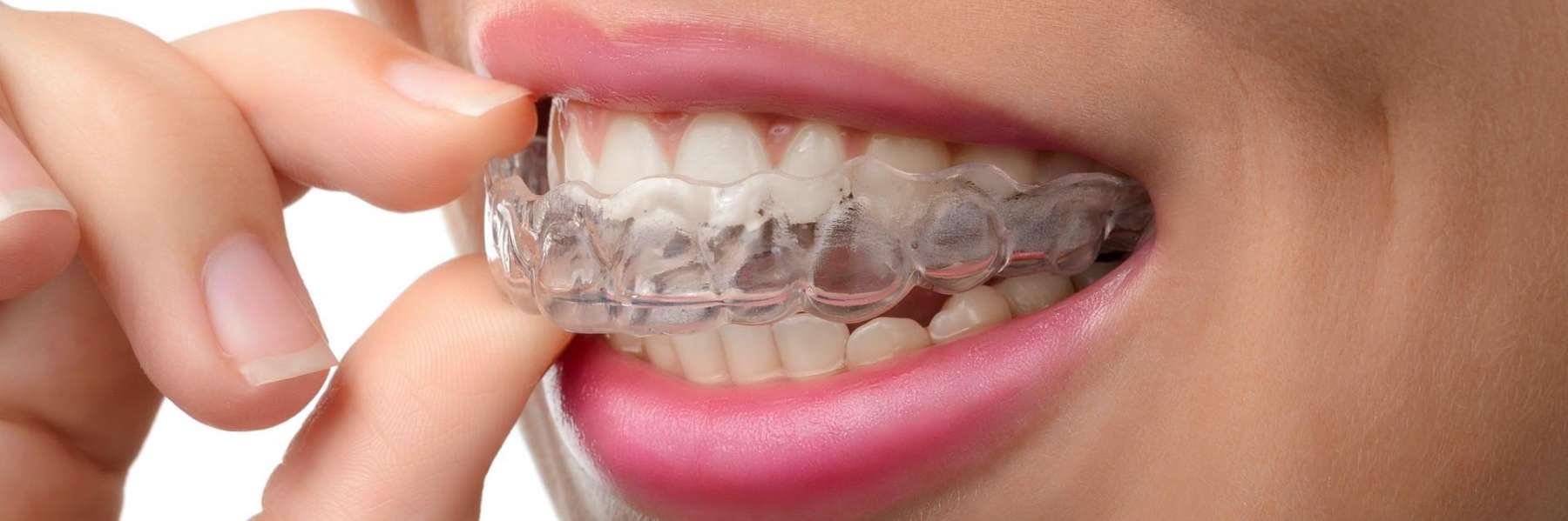 straight teeth result| orthodontic treatment in Humble TX