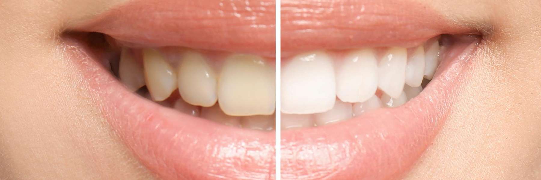 Before and after teeth whitening in Humble TX