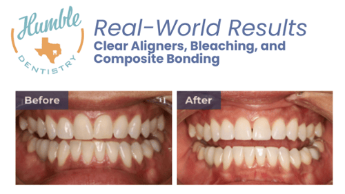 smile before and after makeover in humble, tx