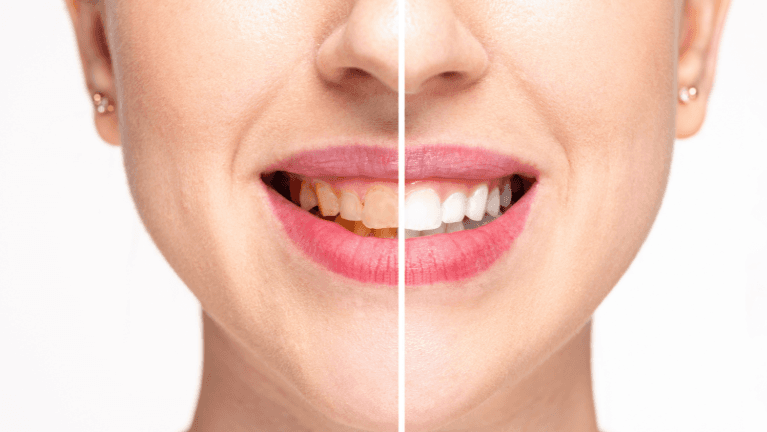 before and after teeth whitening in humble