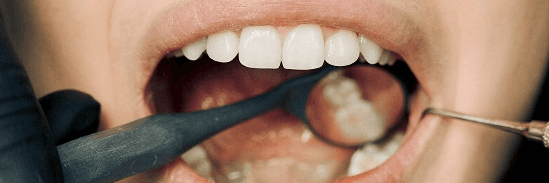teeth whitening process in humble