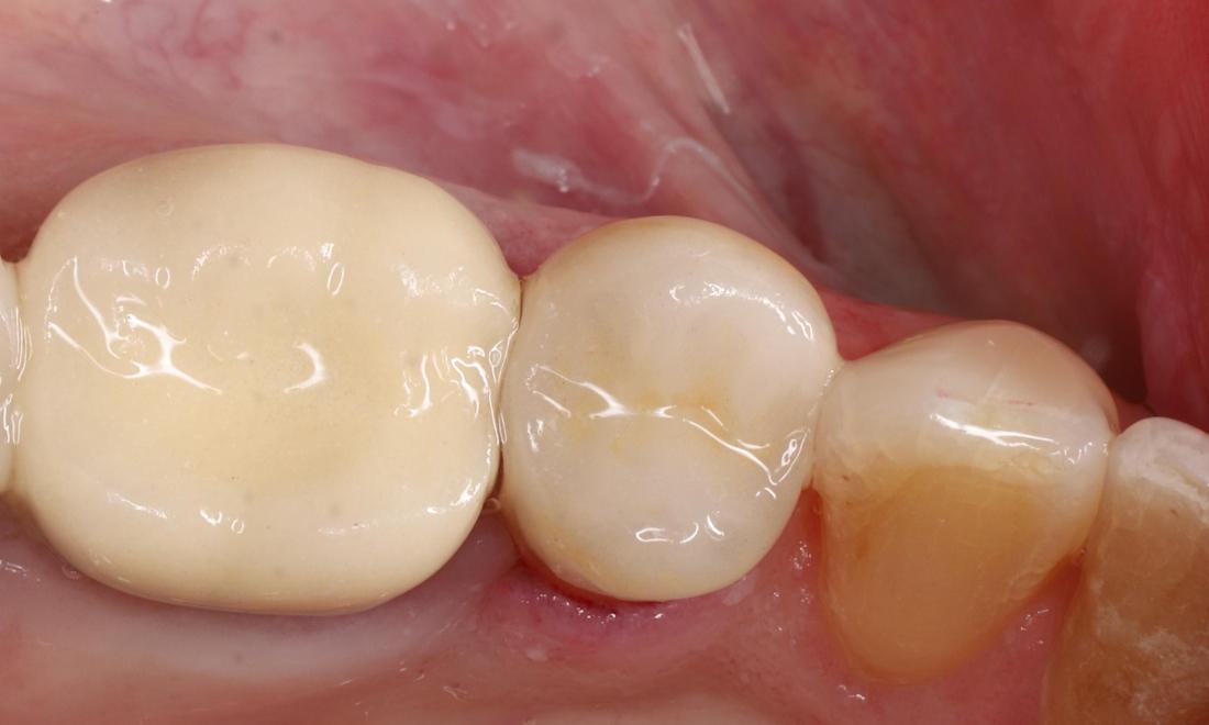 After treatment with all ceramic tooth colored onlay