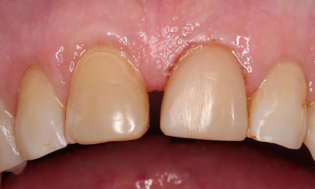 a front tooth with a veneer on it, repairing the chip | humble tx dental veneers