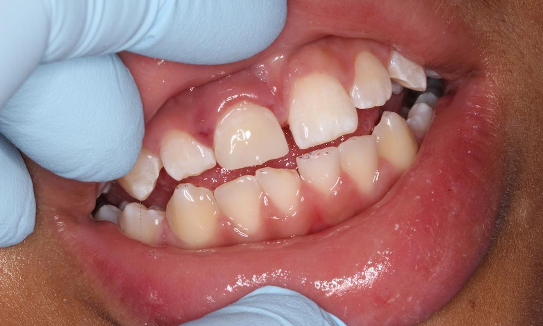 Tooth colored filling, repaired tooth | humble general dentist