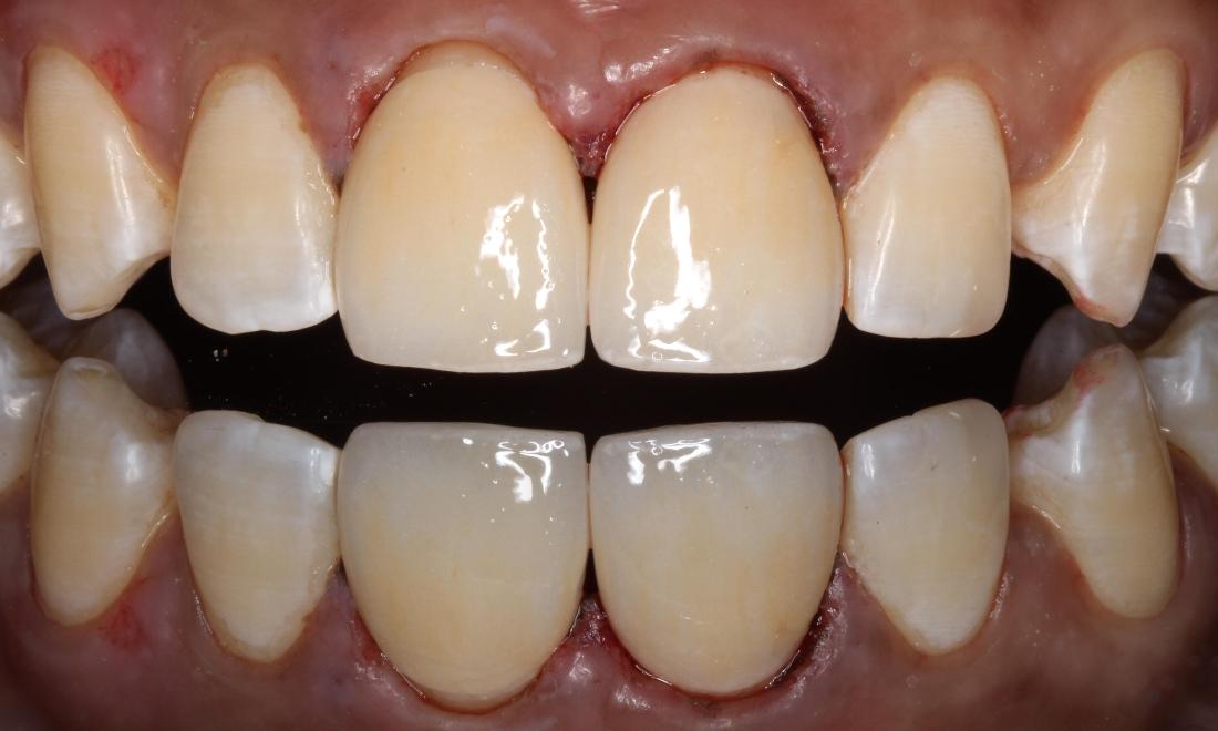 a smile with dental crowns, fixing chipped teeth | humble tx dental crowns