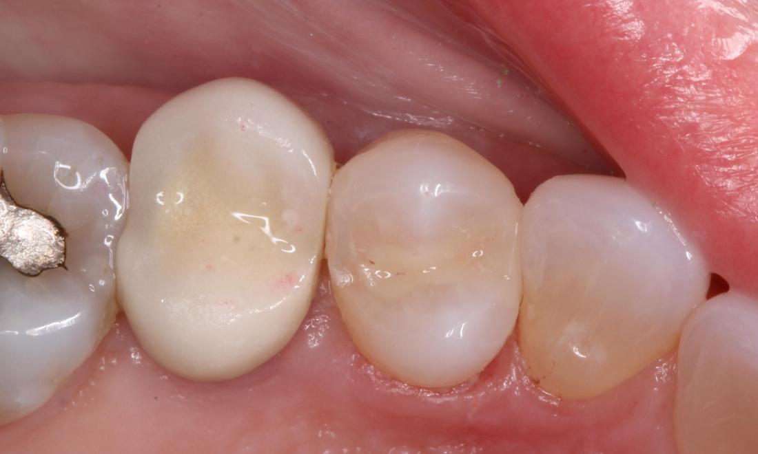new tooth colored filling