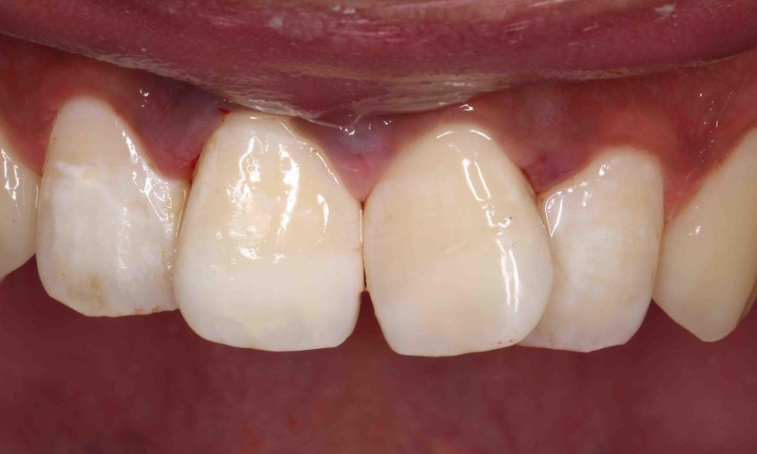 broken tooth replaced with veneers | humble tx dentist