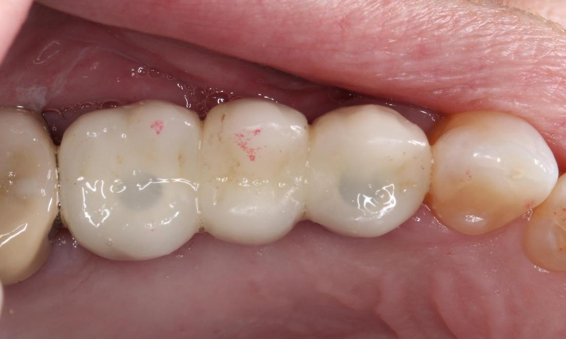 implant supported bridge, tooth replacement | humble tx dental implants