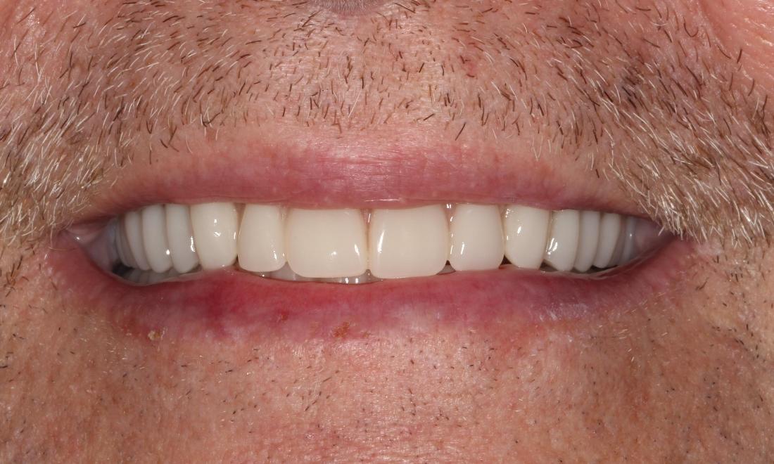 a smile with a full set of teeth, created by implant retained dentures | humble tx dental implants