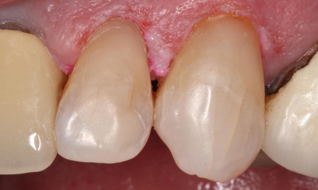After treatment with direct composite filling material