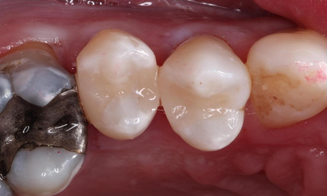 After treatment with direct composite filling material