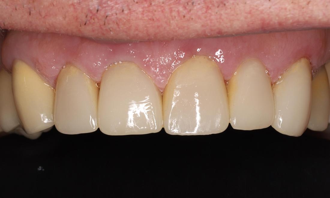 After treatment with crowns and veneers on upper front teeth