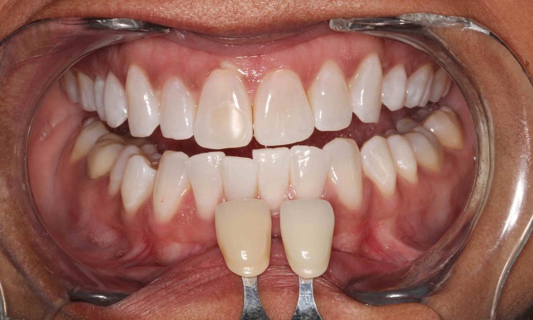 teeth whitened using Zoom teeth whitening | professional teeth whitening humble tx