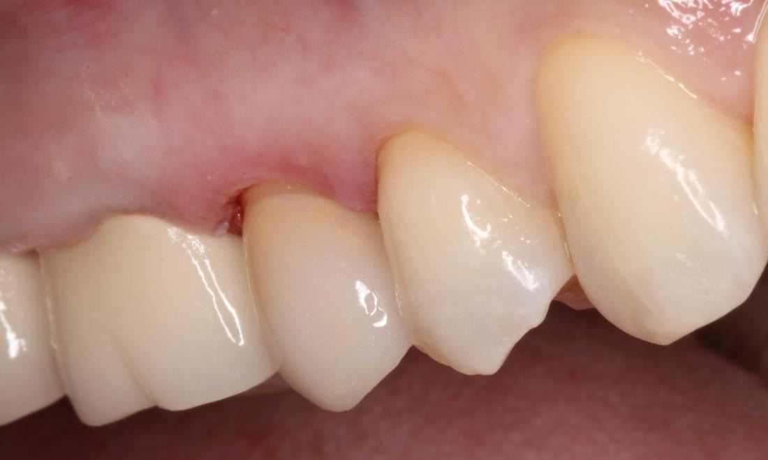 Crown bonded into place, restoring esthetics, strength, and function