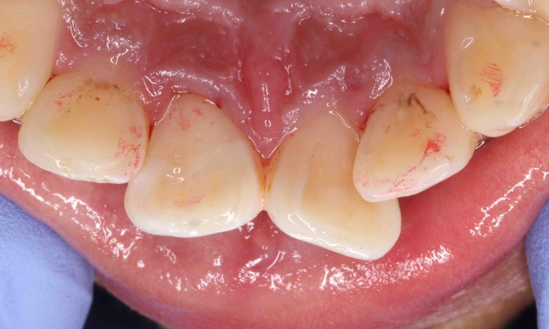 broken tooth repaired with veneers underneath | humble tx dentist
