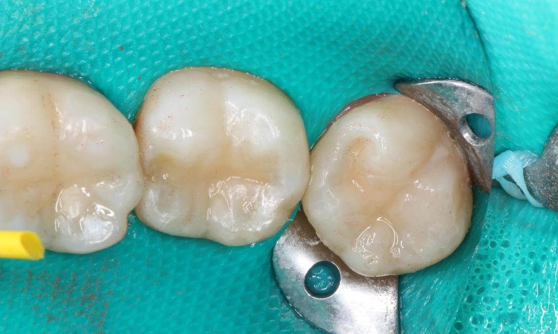 white composite filling, tooth colored filling, polished fillings | dentist in humble