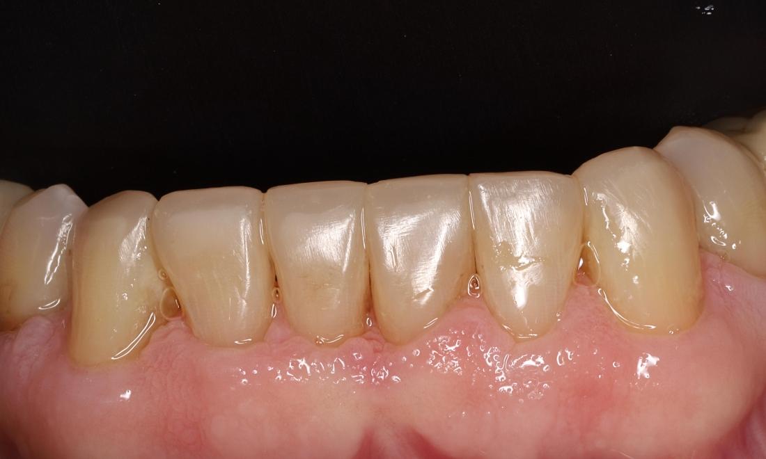 After treatment with direct composite veneers on the lower front teeth