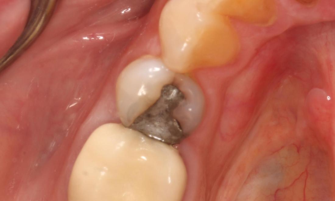 Before treatment, large silver filling with decay