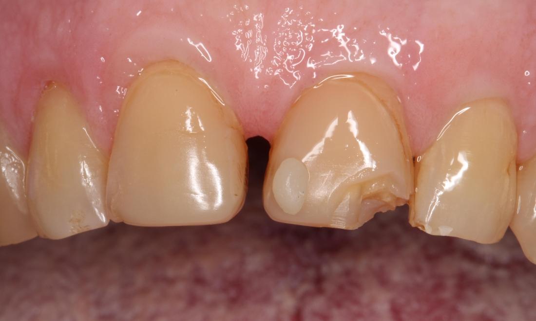 a front tooth with a chip | veneers humble tx