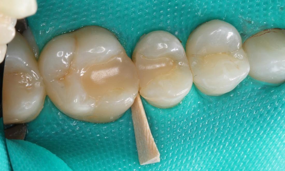 rear teeth before a composite filling between them | dentist humble tx