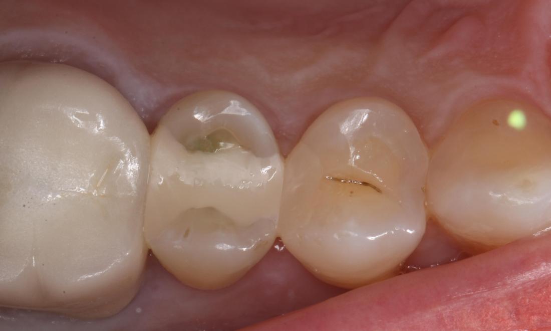 Tooth built up with tooth colored composite resin