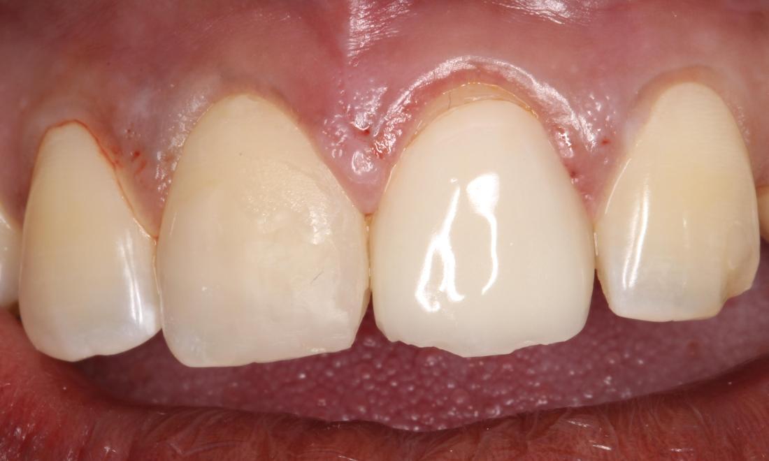 a smile with chipped teeth after an incident at work | dentist humble tx