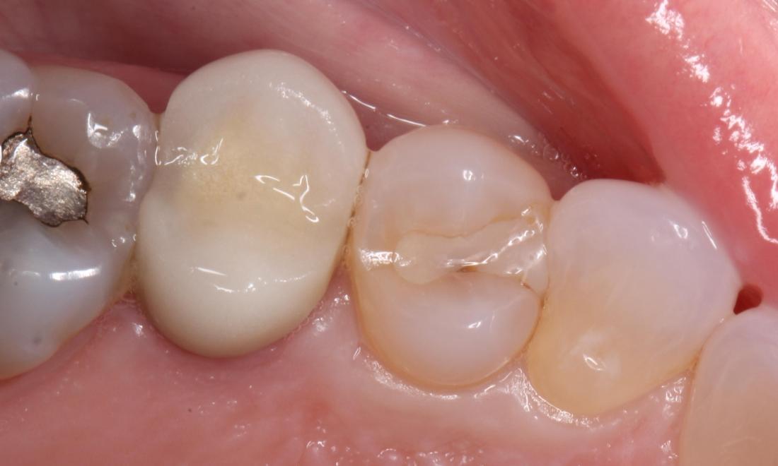 decay around tooth colored filling