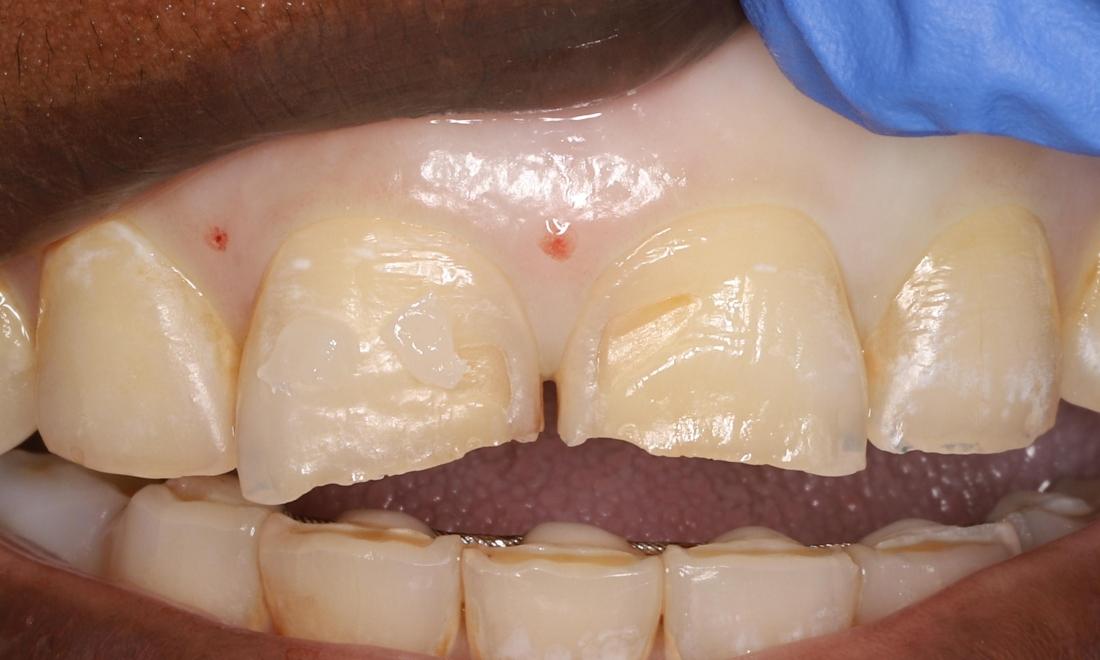 before with chipped tooth