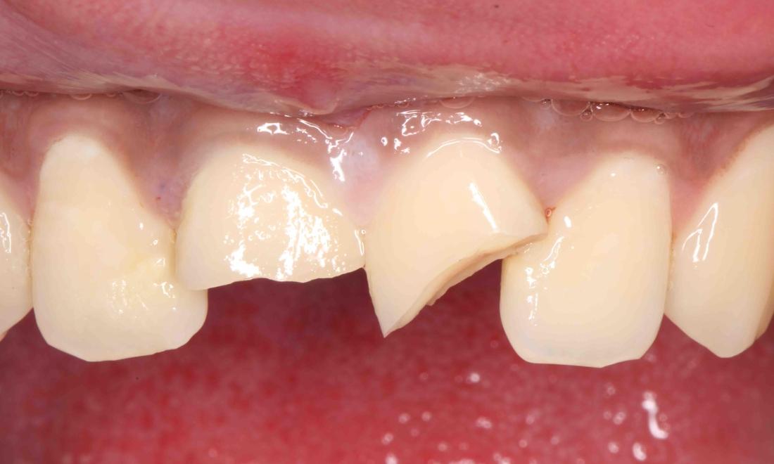broken front teeth | humble tx dentist