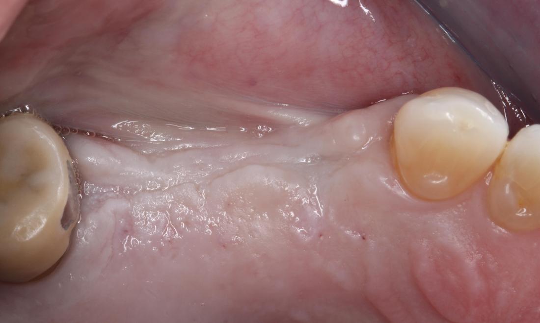 missing teeth, edentulous space | dental implants humble tx