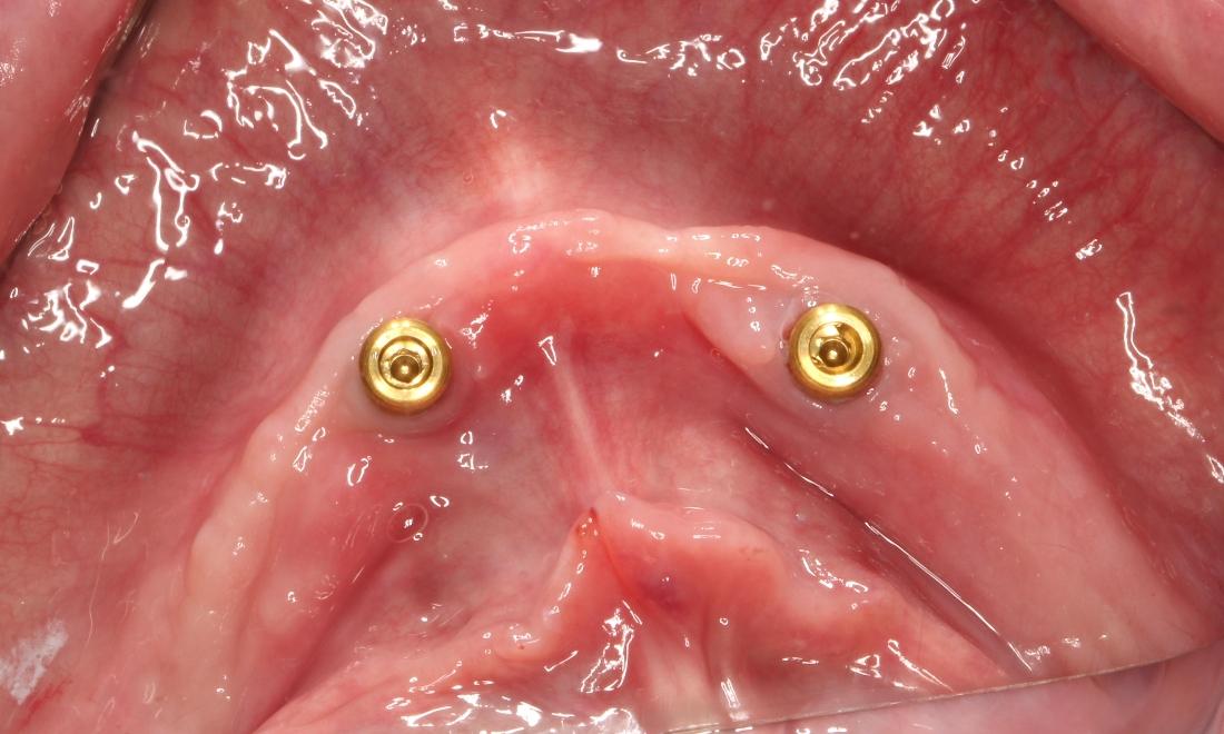 a person's mouth, with no teeth and two implant posts, without crowns | dental implants humble tx