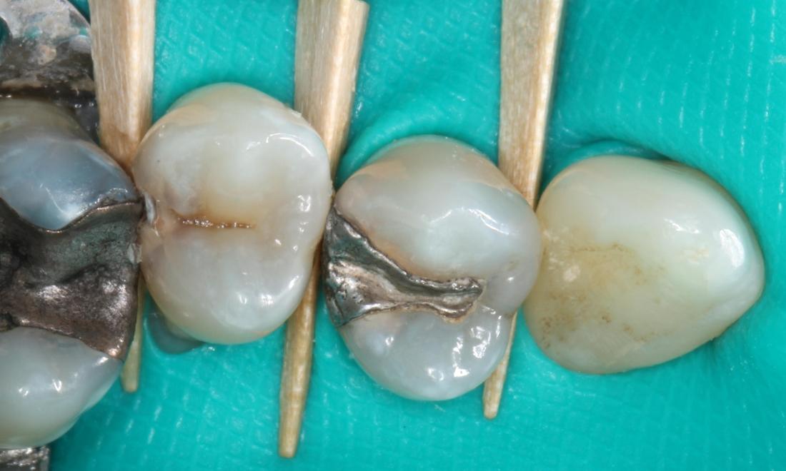 Pre-treatment showing teeth with decay