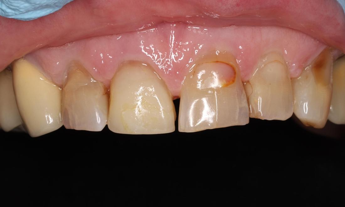 Before treatment, spaces between teeth, chipped and worn teeth, discolored teeth