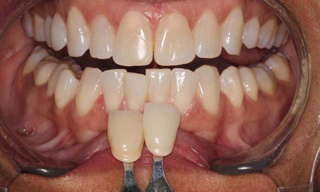 stained teeth due to wear and tear | humble tx zoom whitening