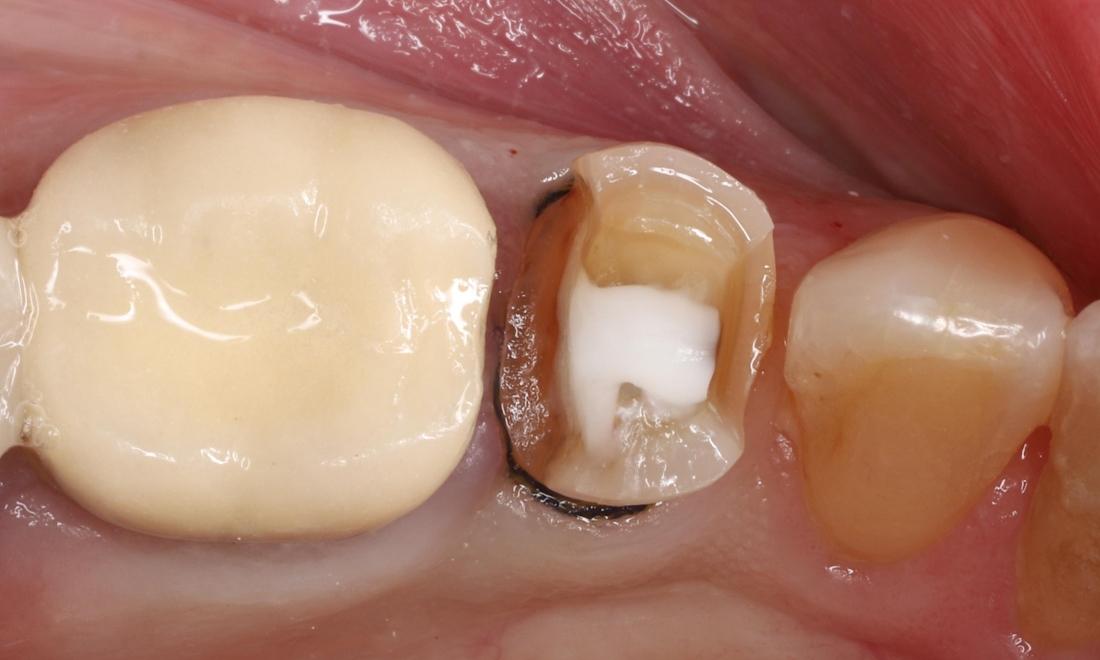 During treatment showing white buildup material and tooth prepared for onlay