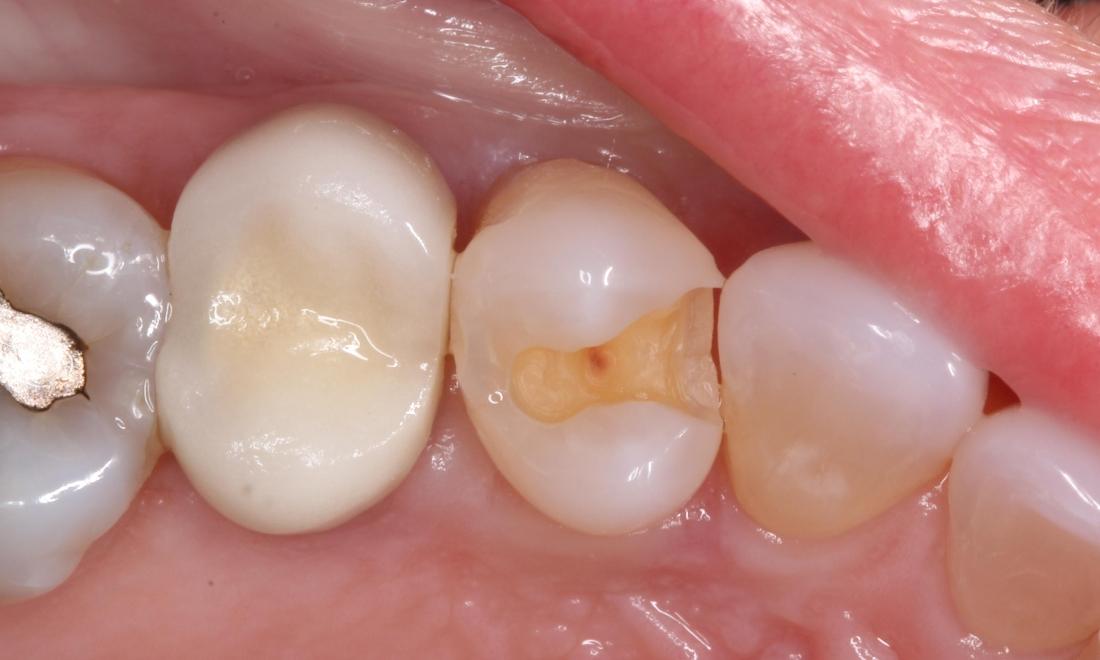old tooth colored filling and decay removed