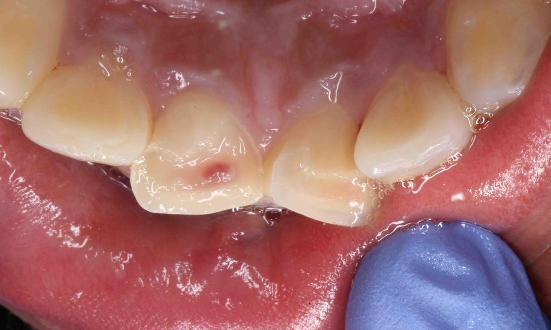 chipped tooth underneath | humble tx dentist