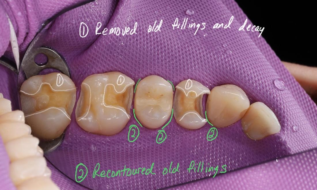 During treatment showing old fillings removed and adjacent teeth recontoured