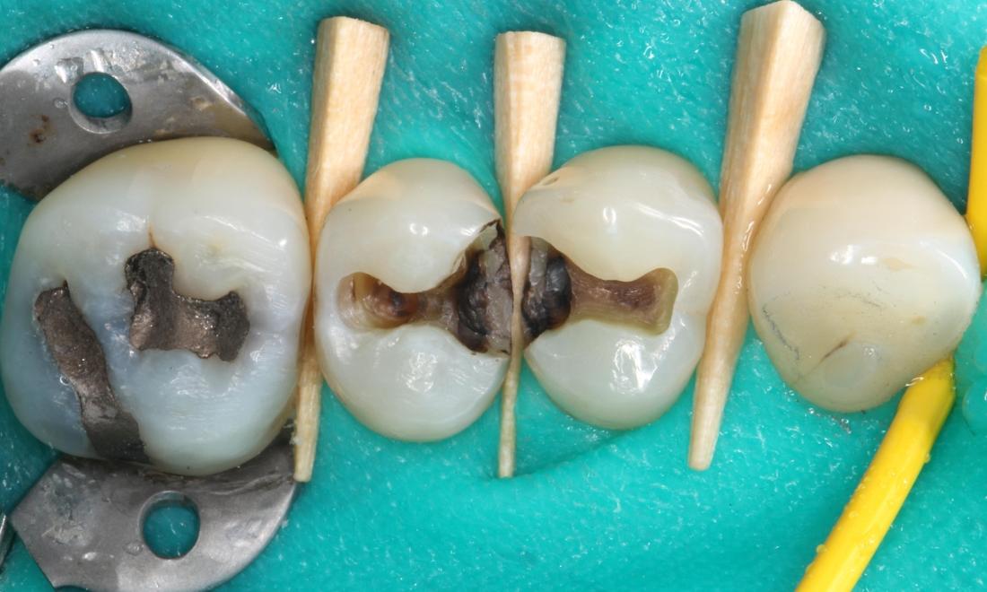 Silver fillings removed showing decay