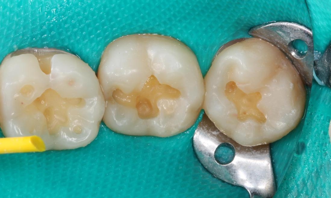 dental dam, cavities removed | dental fillings in humble