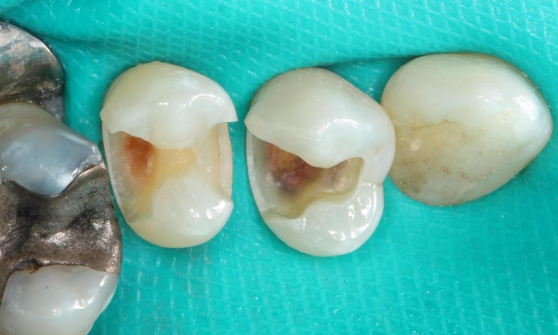 During treatment showing decay and old silver filling removed