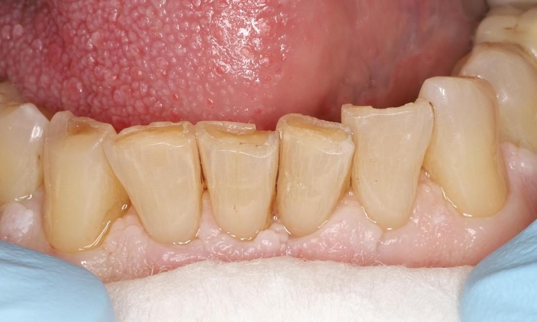 Before treatment lower front teeth with wear, chipping, rotations