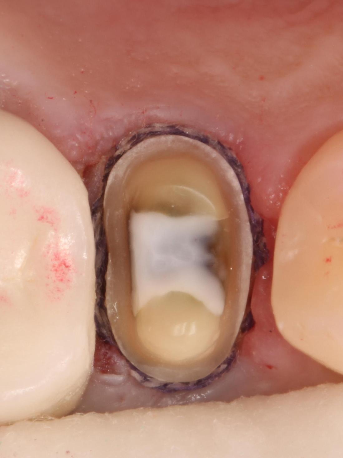 Tooth prepared for the crown
