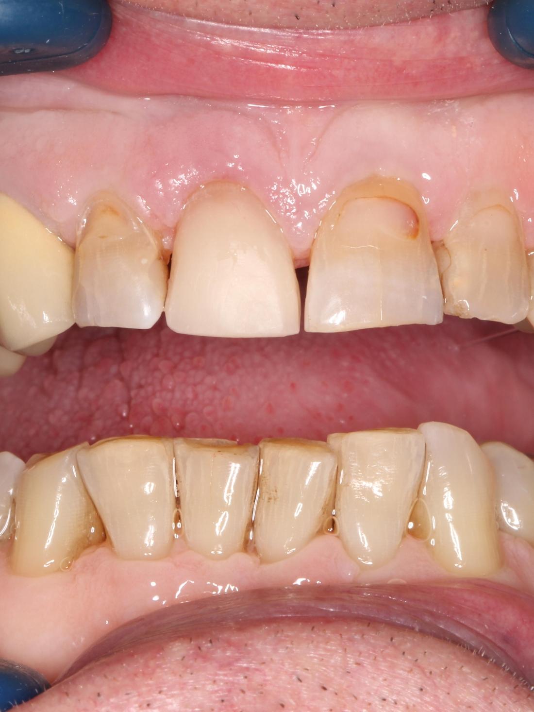 Before treatment, worn and chipped teeth with spaces and discoloration